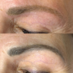 laser removal