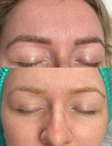 Laser tattoo removal